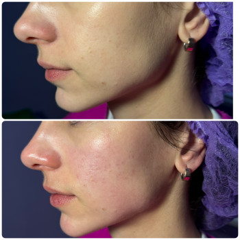 Омолодження, фото - косметолог Ольга Мельник