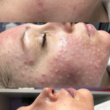 Мезотерапія, фото - косметолог Ольга Мельник