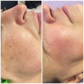 Видалення пігментації, фото - косметолог Ольга Мельник