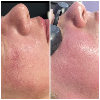 Видалення судин, фото - косметолог Ольга Мельник