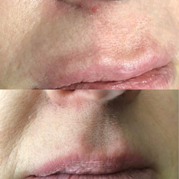 Видалення новоутворень, фото - косметолог Ольга Мельник