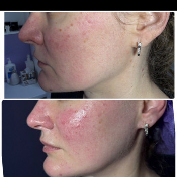 Омолодження 4Д, фото - косметолог Ольга Мельник