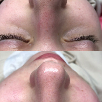 Чистка обличчя, фото - косметолог Ольга Мельник