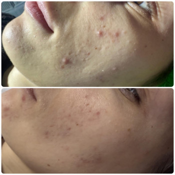 Лікування акне, фото - косметолог Ольга Мельник