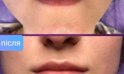 Увеличение губ Косметолог  Харків