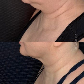 зменьшення жирових відкладень нижньої третини обличчя і шиї