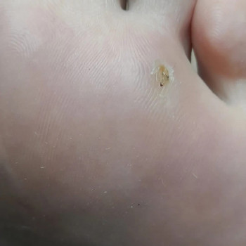 Бородовка на стопі ДО/