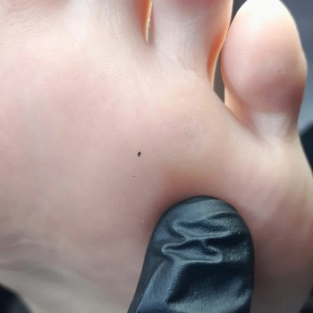 Видалення бородовки на стопі ПІСЛЯ/