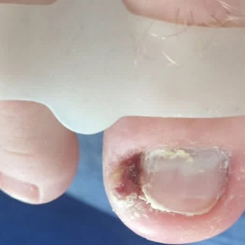 Врослий ніготь ДО/