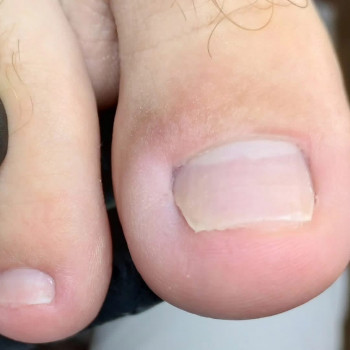 Видалення врослого нігтя ПІСЛЯ/