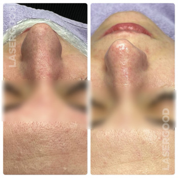 Комбінована чистка обличчя
                    Косметологический центр LASERGOOD Черновцы