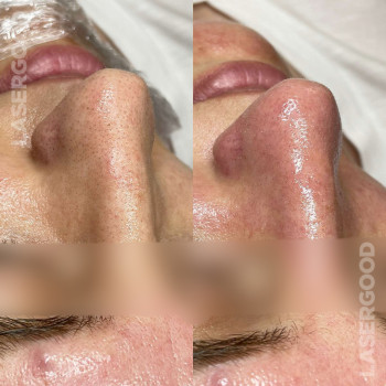 Механічна чистка обличчя
                    Косметологічний центр LASERGOOD Чернівці