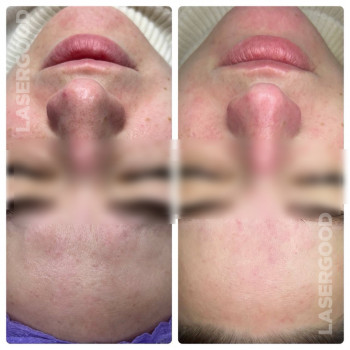 Механічна чистка обличчя
                    Косметологічний центр LASERGOOD Чернівці