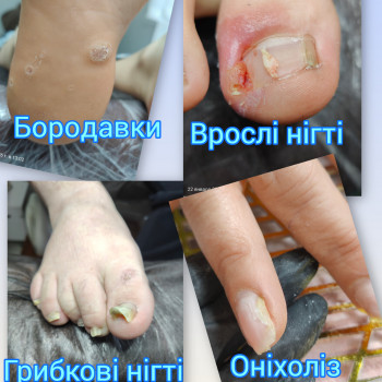  #видаленнябородовок, #вросліныгті