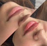 Об’єм, який виглядає дорого 💋 Акція -25% .Натурально, гармонійно, виразно. Врач-косметолог Натали Киев