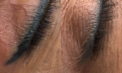 Удаления татуажа ремувером Майстер перманентного макіяжу Татьяна Вінниця