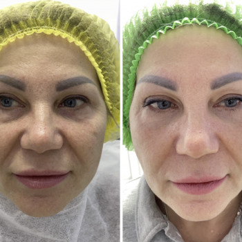 Результат після 1 процедури в поєднанні з полінуклеотидами