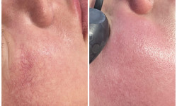 IPL система Cellec V з охолодженням Косметолог Оля Біла Церква