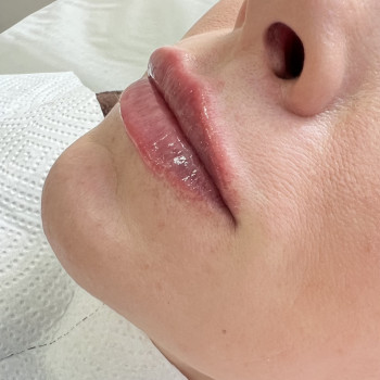 Збільшення губ
Та підборіддя
 #збільшенняпідборідя #косметологзапоріжжя