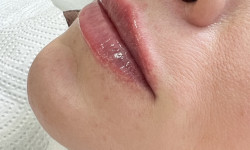 Збiльшення пiдборiддя Студия лазерной эпиляции Laser Kosmo Запорожье