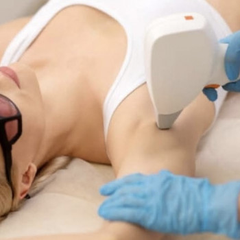 Лазерна епіляція