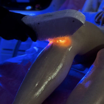 Лазерна епіляція