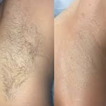 Епіляція зони пахви