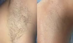 Чоловіча лазерна епіляція Студия лазерной эпиляции Laser Kosmo Запорожье