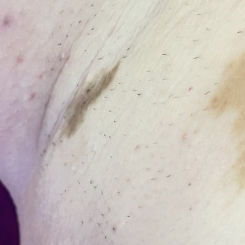 Лазерна епіляція пахви з ветіліго
На фото 4 процедура