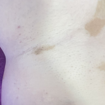 Лазерна епіляція пахви з ветіліго
На фото 4 процедура