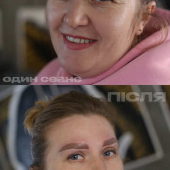 Видалення тату та перманенту
                    Тату салон TATTOO LAMARCH Одеса