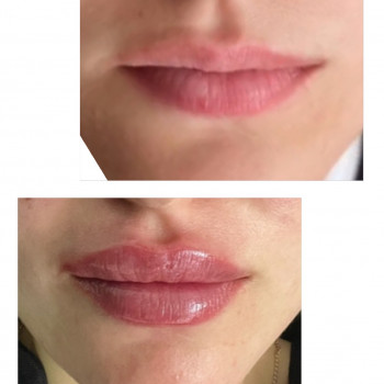 Аугментація губ