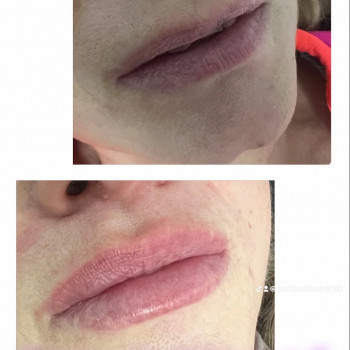 Корекція вікових губ