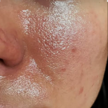 КОЛИ ПОРА ЗВЕРНУТИСЯ ДО КОСМЕТОЛОГА?
 ⁣⁣⠀
 Домашній догляд – обов'язковий щоденний ритуал, проте деякі проблеми може вирішити лише кваліфікований майстер!⁣⁣⠀
 ⁣⁣⠀
 Ось кілька ознак того, що вам необхідно відвідати косметолога:
 ⁣⁣⠀⁣⁣⠀
 ✔️Розширені, «забиті» пори, комедони, жирна шкіра.⁣⁣⠀
 ⁣⁣
 В даному випадку вам обов'язково потрібно відвідати косметолога на предмет проведення чищення обличчя, різних доглядів для жирної та комбінованої шкіри та мезотерапії.
 ⁣⁣⠀
 ✔️Суха шкіра з дрібни