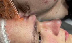 Ультразвукова чистка обличчя Косметолог-эстетист Ольга Чернигов