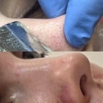 Комбінована чистка обличчя Дерматолог косметолог Нелли Киев