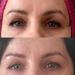 Мезотерапія для повік Дерматолог косметолог Нелли Киев