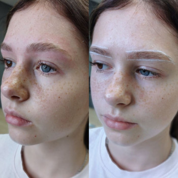 Структурна корекція брів