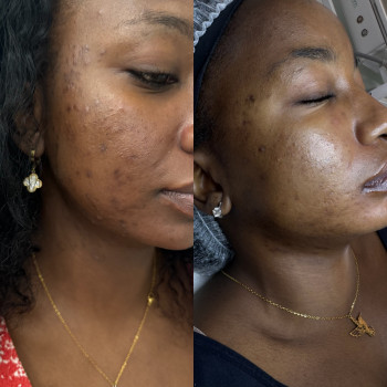 Лечение акне, фото - косметолог-ін'єкціоніст Валерія Колеснікова