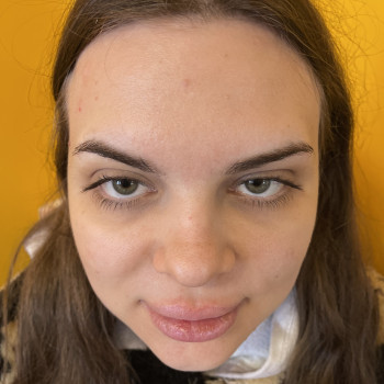 Ботулинотерапия верхней трети лица, фото - косметолог-инъекционист Ольга Сигорских