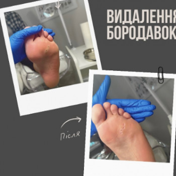 Фото з портфоліо клініки Manicure & Pedicure (центри подології, Софіївська Борщагівка)