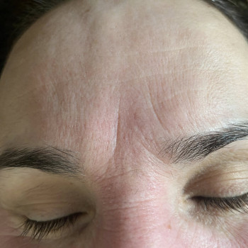 Після 10 масажу. Курс масажу-10 процедур з переривами в декілька днів.