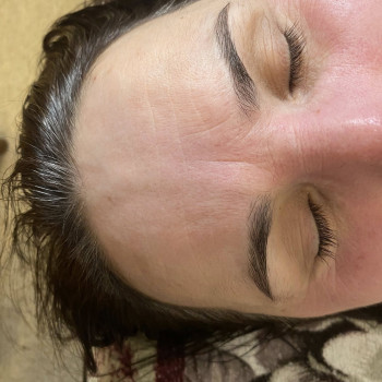 Після 10 масажу. Курс склав 10 процедур.