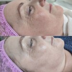 Киснева мезотепарія Косметологічний центр Косметичний кабінет Рівне