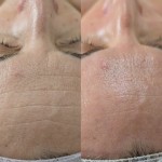 Біоревіталізація без ін'єкцій,за допомогою пілінгу біоревіталізанта KEMIKUM Косметологический центр Косметичний кабінет Ровно