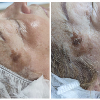 5 процедури інтервал 10 днів