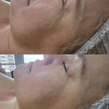 1 процедура