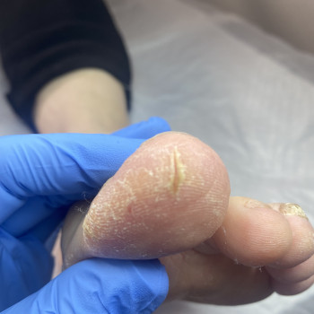 ДО/
Подологічна обробка тріщин шкіри стопи (етап “до”): первинна антисептична обробка, оцінка локал...