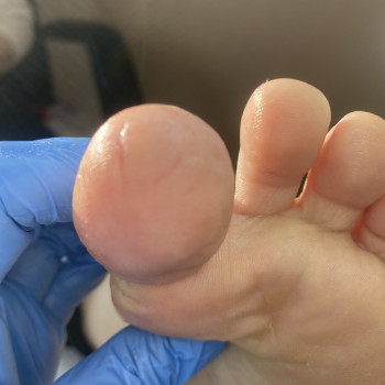 ПІСЛЯ/
Подологічна обробка тріщин після процедури: повторна антисептична обробка, контроль стану тр...