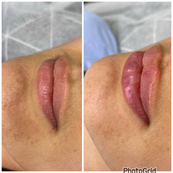 Увеличение губ,1мл ,